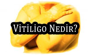 Vitiligo Nedir? Kimlerde Görülür? Vitiligo Hastalığının Sebepleri