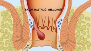 Basur Hastalığı: Hemoroit
