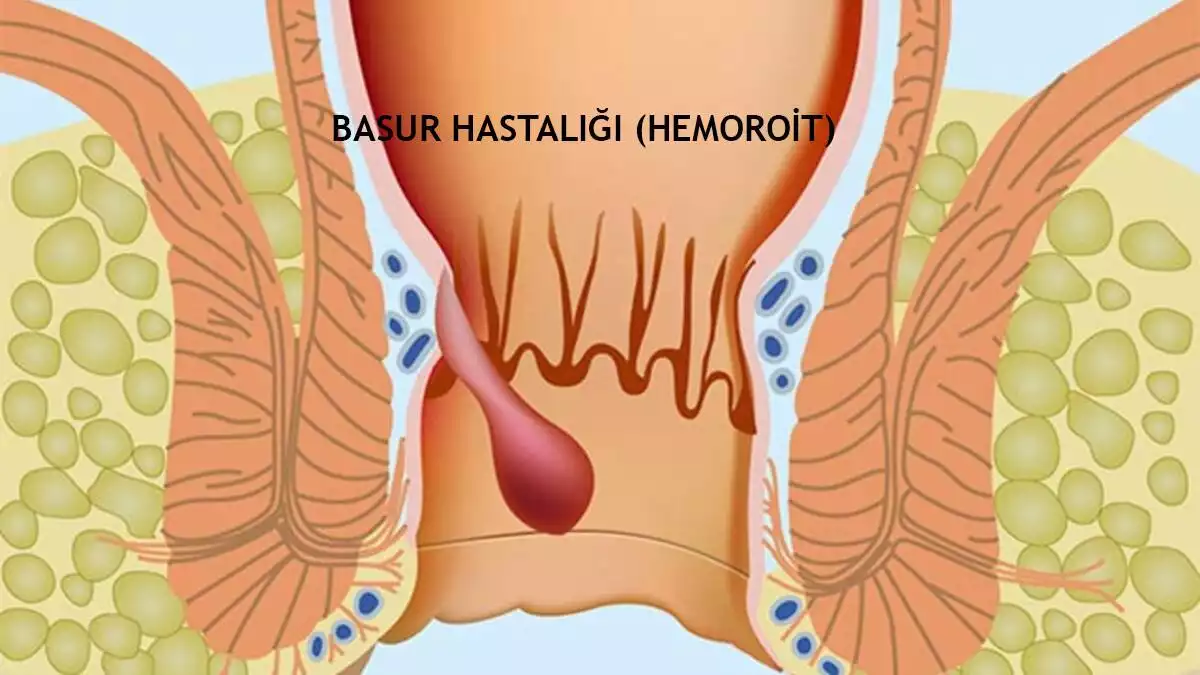 Basur Hastalığı: Hemoroit