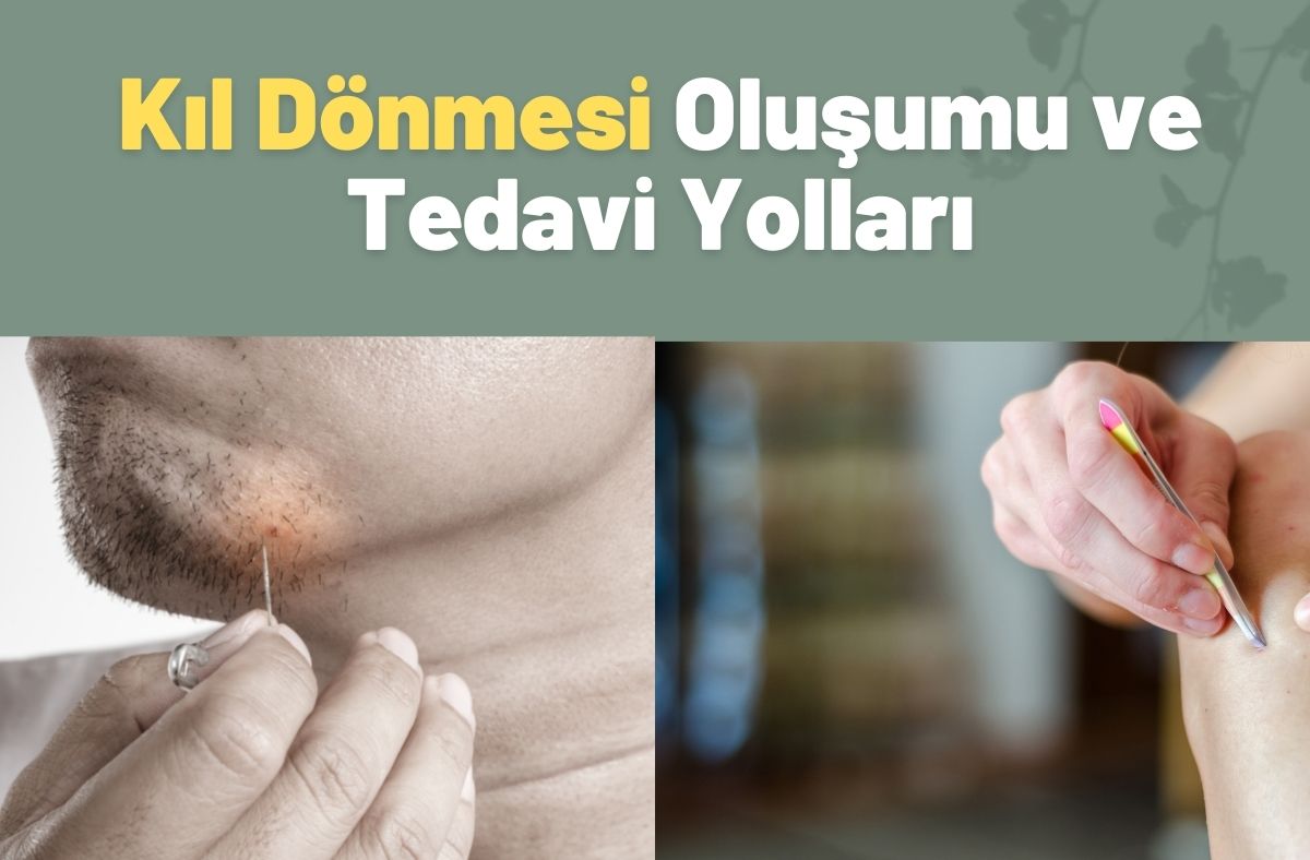 Kıl Dönmesi Oluşumu ve Tedavi Yolları
